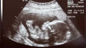 Ultrasound